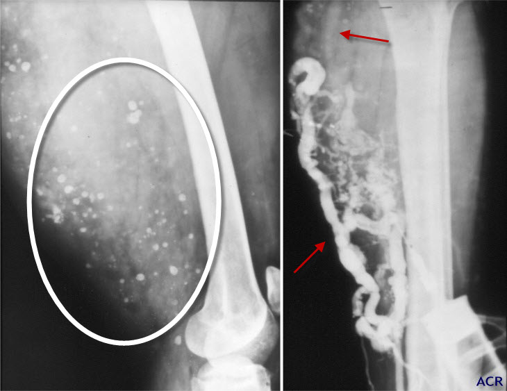 cavernous Hemangioma